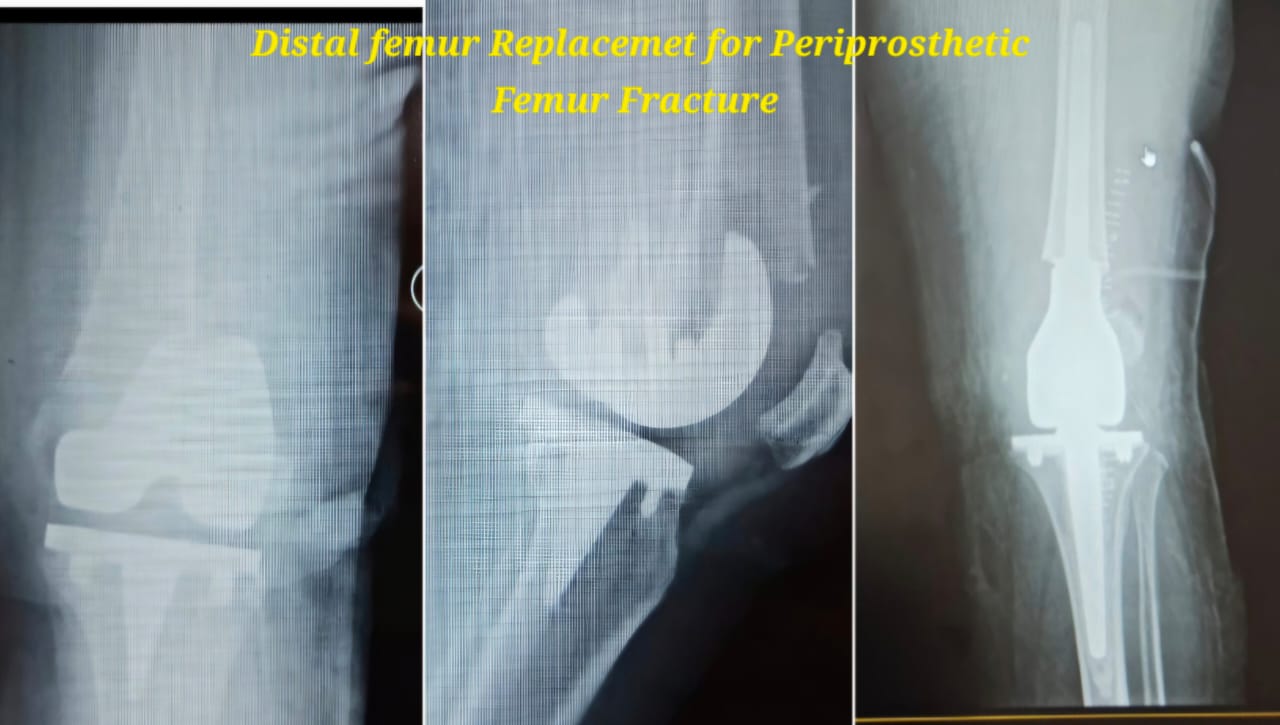 Knee X-ray 5
